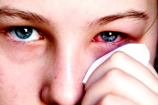 Cẩn thận trong phòng tránh bệnh đau mắt đỏ