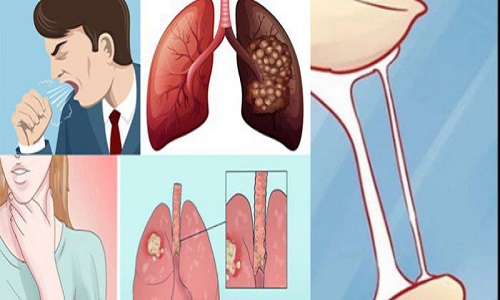 Những dấu hiệu cảnh báo sớm bệnh ung thư phổi