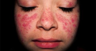 dấu hiệu nhận biết bệnh lupus ban đỏ