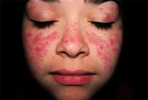 dấu hiệu nhận biết bệnh lupus ban đỏ 